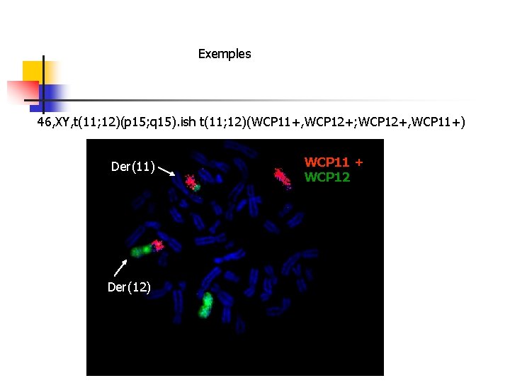 Exemples 46, XY, t(11; 12)(p 15; q 15). ish t(11; 12)(WCP 11+, WCP 12+;