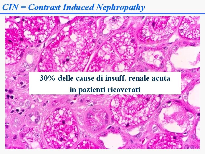 CIN = Contrast Induced Nephropathy 30% delle cause di insuff. renale acuta in pazienti