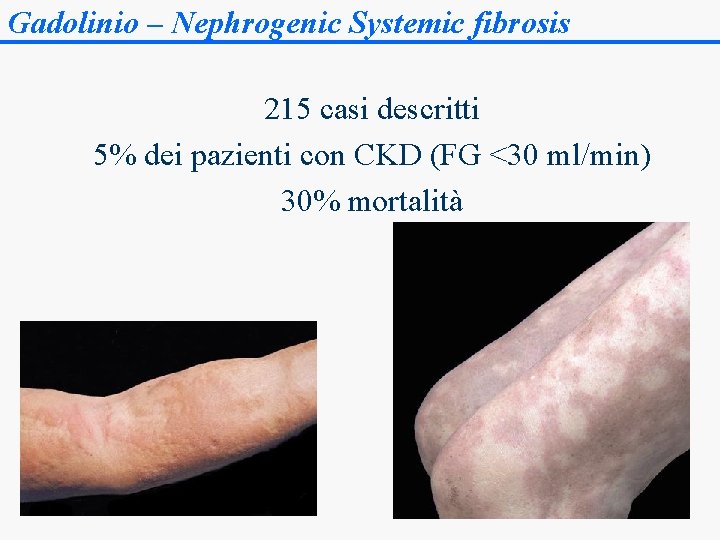 Gadolinio – Nephrogenic Systemic fibrosis 215 casi descritti 5% dei pazienti con CKD (FG