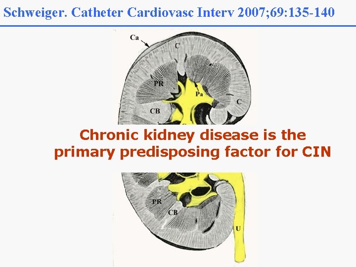 Schweiger. Catheter Cardiovasc Interv 2007; 69: 135 -140 Chronic kidney disease is the primary