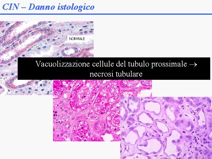 CIN – Danno istologico NORMALE Vacuolizzazione cellule del tubulo prossimale necrosi tubulare 