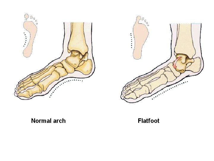 Normal arch Flatfoot 
