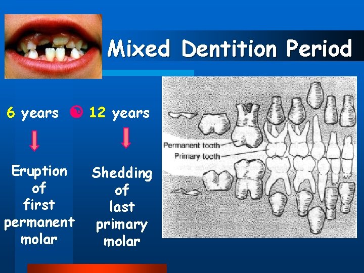 Mixed Dentition Period 6 years 12 years Eruption of first permanent molar Shedding of