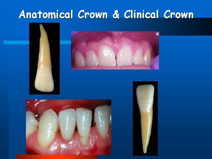 Anatomical Crown & Clinical Crown 