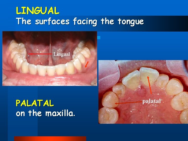 LINGUAL The surfaces facing the tongue PALATAL on the maxilla. palatal 