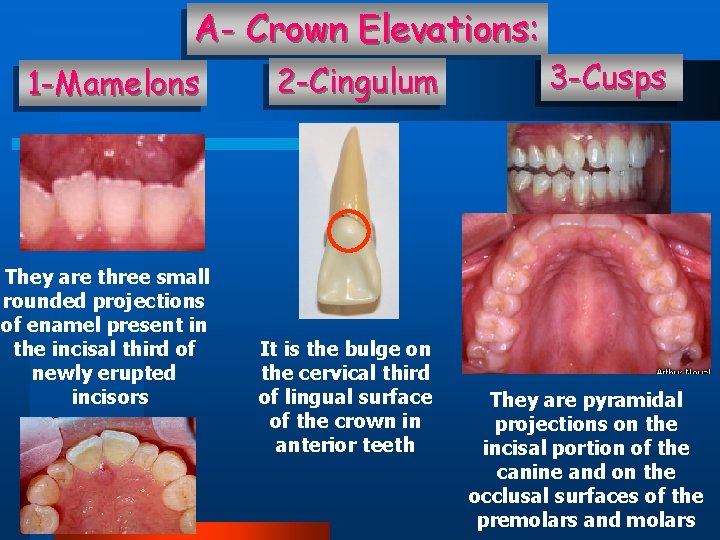 A- Crown Elevations: 1 -Mamelons They are three small rounded projections of enamel present