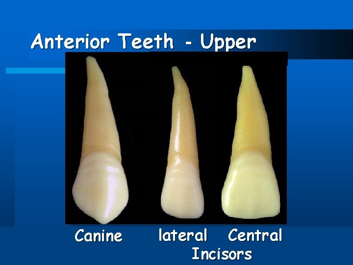 Anterior Teeth - Upper Canine lateral Central Incisors 