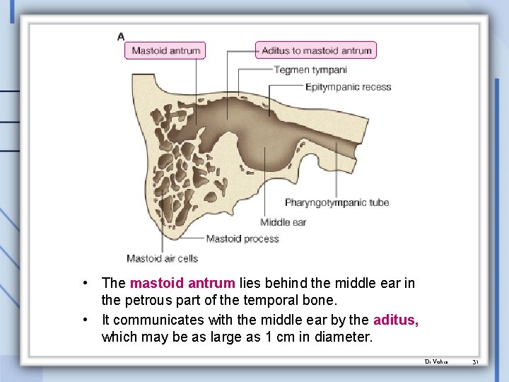  • The mastoid antrum lies behind the middle ear in the petrous part