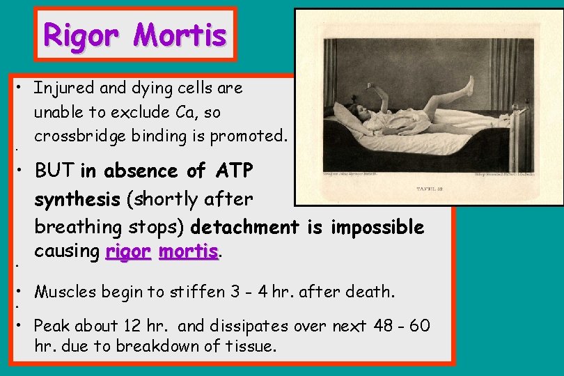 Rigor Mortis • Injured and dying cells are unable to exclude Ca, so crossbridge