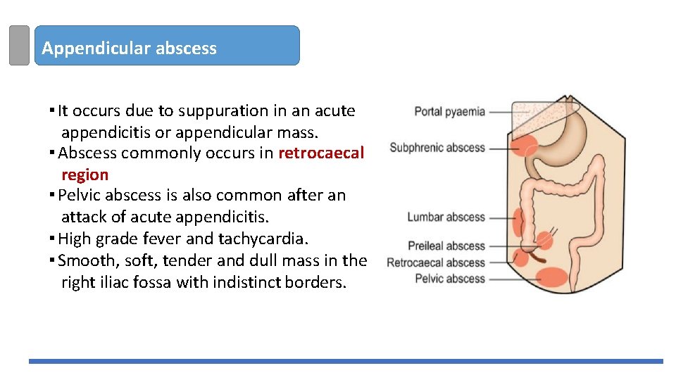 Appendicular abscess ▪ It occurs due to suppuration in an acute appendicitis or appendicular