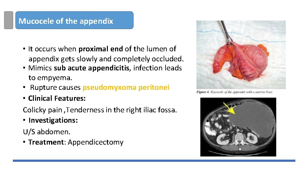 Mucocele of the appendix • It occurs when proximal end of the lumen of