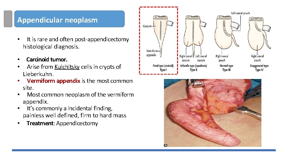 Appendicular neoplasm ▪ It is rare and often post-appendicectomy histological diagnosis. ▪ ▪ Carcinoid