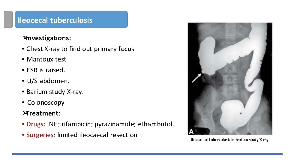 Ileocecal tuberculosis ➢Investigations: • Chest X-ray to find out primary focus. • Mantoux test