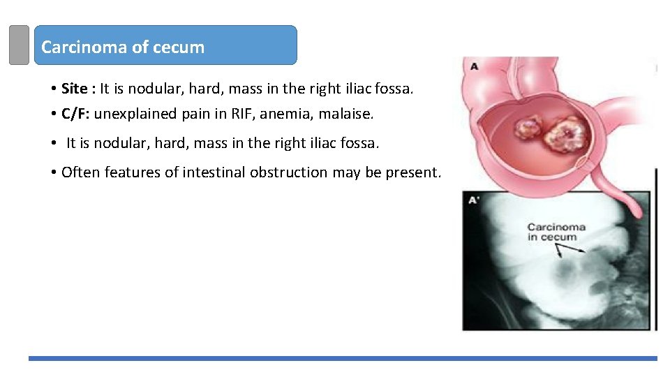 Carcinoma of cecum • Site : It is nodular, hard, mass in the right