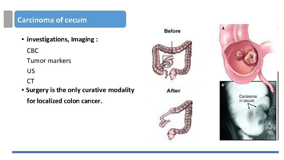 Carcinoma of cecum • investigations, Imaging : CBC Tumor markers US CT • Surgery