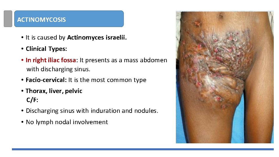 ACTINOMYCOSIS • It is caused by Actinomyces israelii. • Clinical Types: • In right