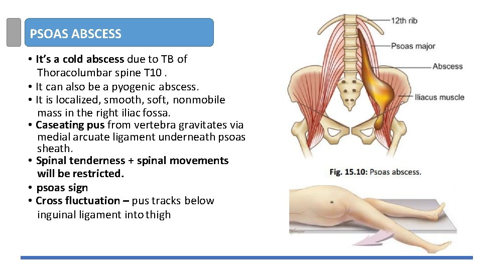 PSOAS ABSCESS • It’s a cold abscess due to TB of Thoracolumbar spine T