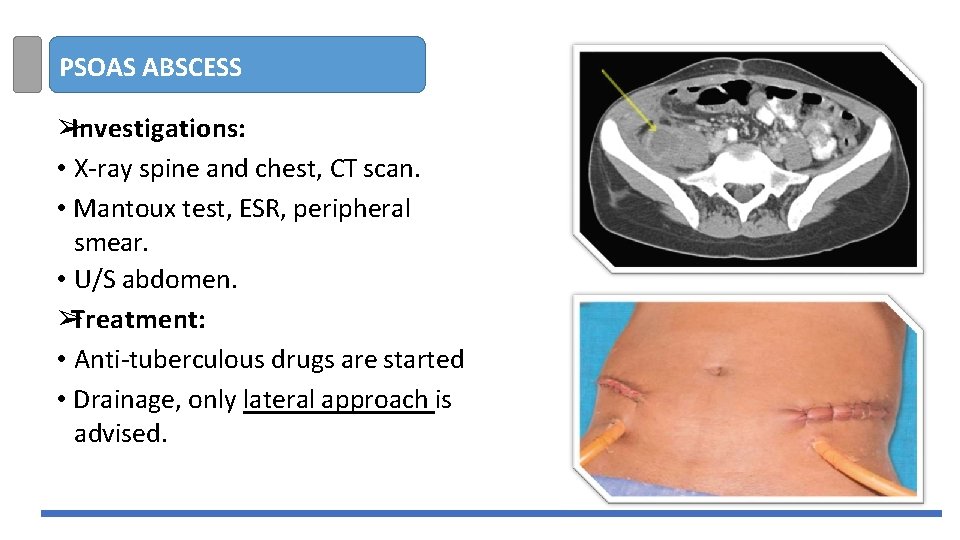 PSOAS ABSCESS ➢Investigations: • X-ray spine and chest, CT scan. • Mantoux test, ESR,