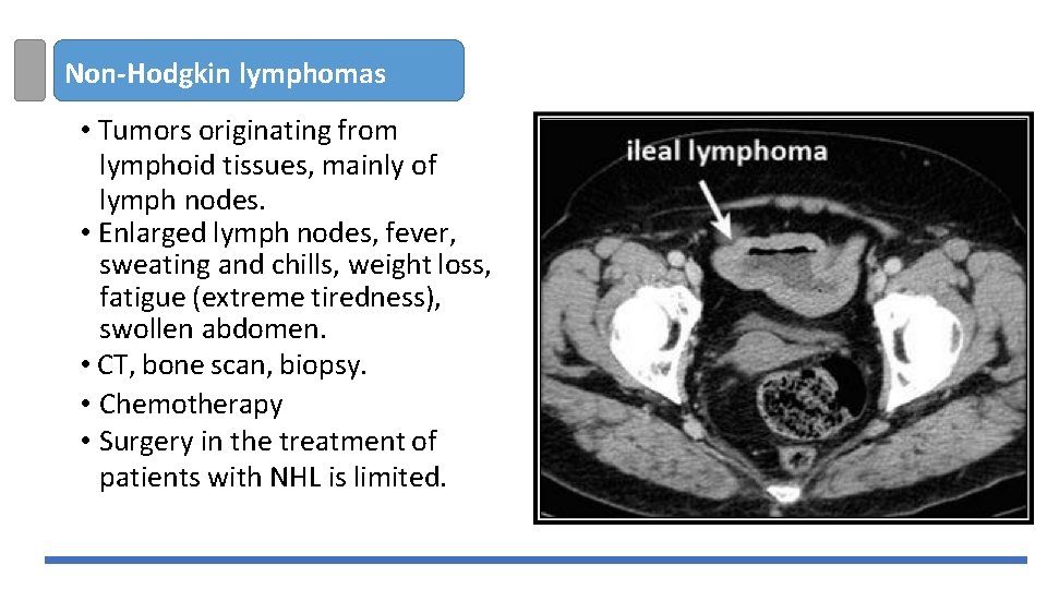 Non-Hodgkin lymphomas • Tumors originating from lymphoid tissues, mainly of lymph nodes. • Enlarged