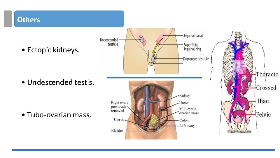 Others • Ectopic kidneys. • Undescended testis. • Tubo-ovarian mass. 