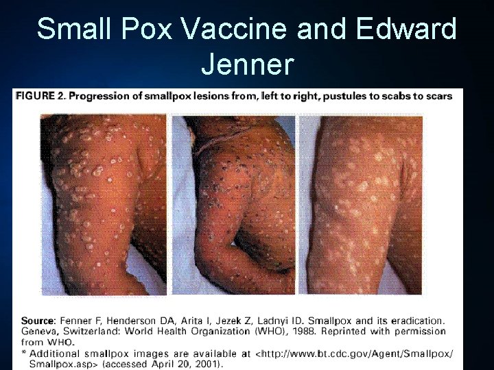 Small Pox Vaccine and Edward Jenner • 