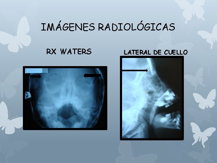 IMÁGENES RADIOLÓGICAS RX WATERS LATERAL DE CUELLO 