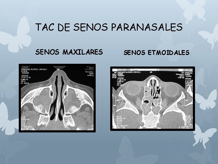 TAC DE SENOS PARANASALES SENOS MAXILARES SENOS ETMOIDALES 