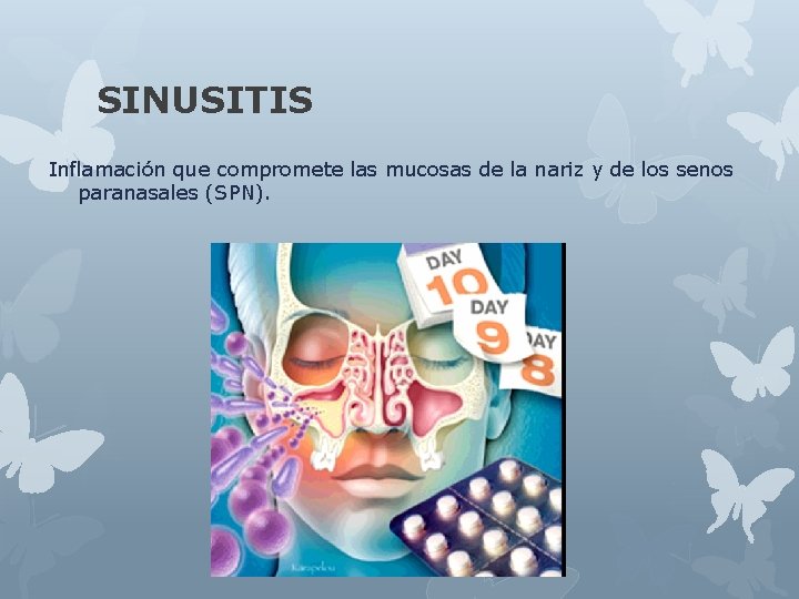 SINUSITIS Inflamación que compromete las mucosas de la nariz y de los senos paranasales