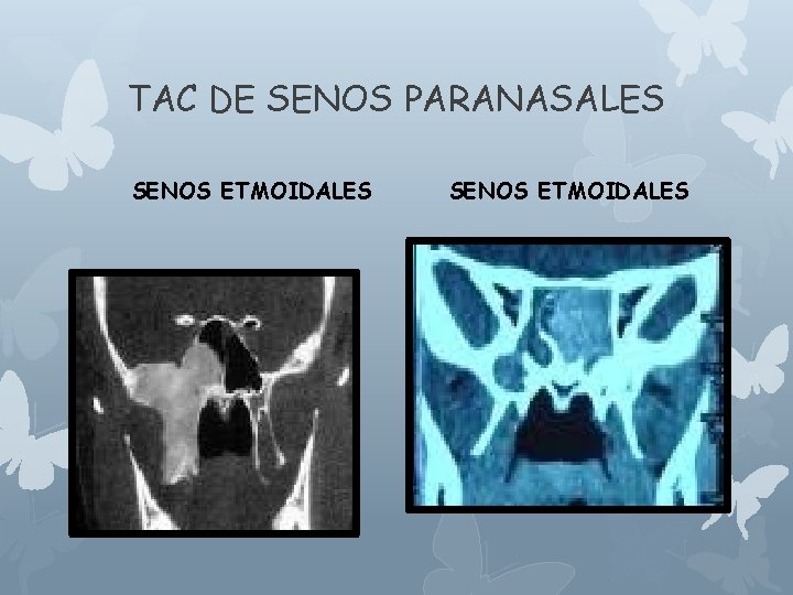 TAC DE SENOS PARANASALES SENOS ETMOIDALES 