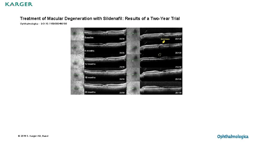 Treatment of Macular Degeneration with Sildenafil: Results of a Two-Year Trial Ophthalmologica - DOI: