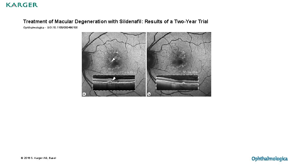 Treatment of Macular Degeneration with Sildenafil: Results of a Two-Year Trial Ophthalmologica - DOI: