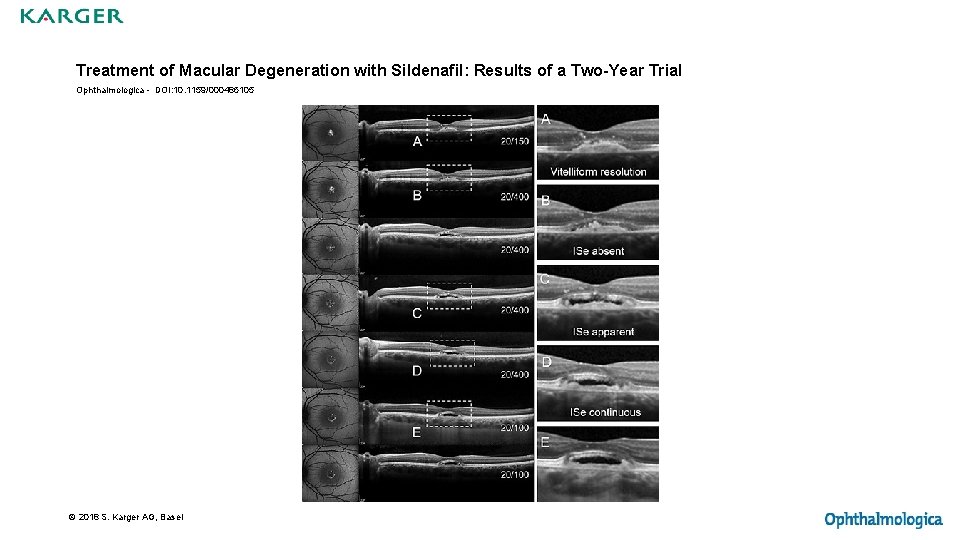 Treatment of Macular Degeneration with Sildenafil: Results of a Two-Year Trial Ophthalmologica - DOI: