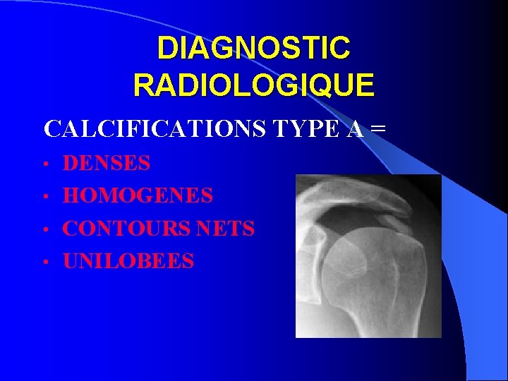 DIAGNOSTIC RADIOLOGIQUE CALCIFICATIONS TYPE A = DENSES • HOMOGENES • CONTOURS NETS • UNILOBEES