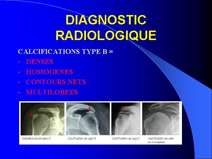 DIAGNOSTIC RADIOLOGIQUE CALCIFICATIONS TYPE B = • DENSES • HOMOGENES • CONTOURS NETS •