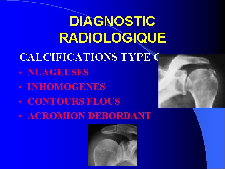 DIAGNOSTIC RADIOLOGIQUE CALCIFICATIONS TYPE C = NUAGEUSES • INHOMOGENES • CONTOURS FLOUS • ACROMION