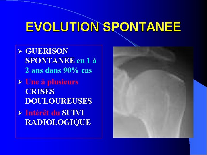 EVOLUTION SPONTANEE GUERISON SPONTANEE en 1 à 2 ans dans 90% cas Ø Une