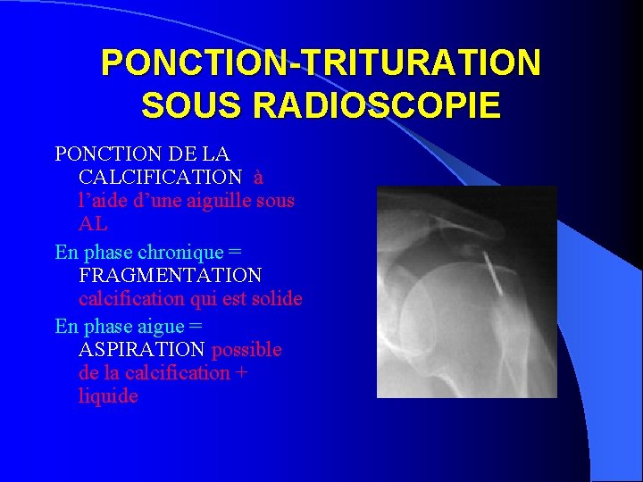 PONCTION-TRITURATION SOUS RADIOSCOPIE PONCTION DE LA CALCIFICATION à l’aide d’une aiguille sous AL En