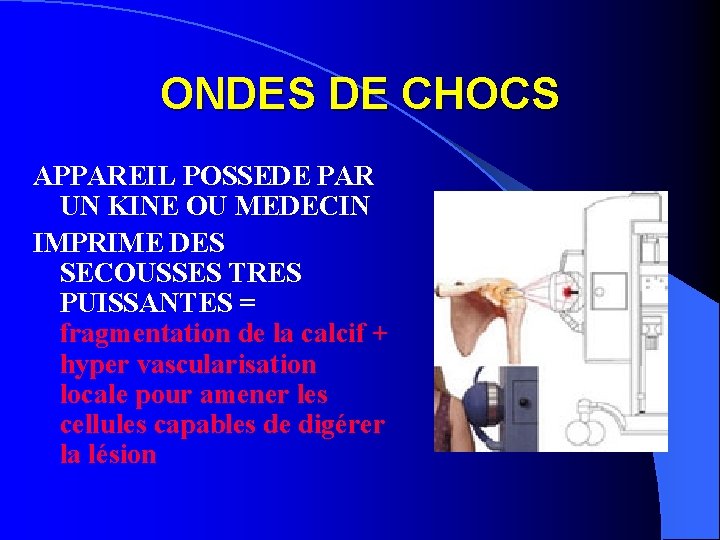 ONDES DE CHOCS APPAREIL POSSEDE PAR UN KINE OU MEDECIN IMPRIME DES SECOUSSES TRES