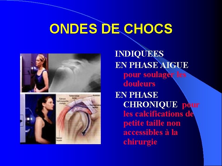 ONDES DE CHOCS INDIQUEES EN PHASE AIGUE pour soulager les douleurs EN PHASE CHRONIQUE