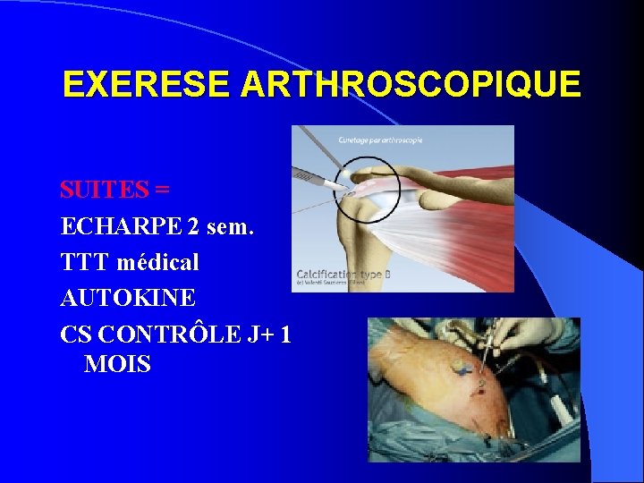EXERESE ARTHROSCOPIQUE SUITES = ECHARPE 2 sem. TTT médical AUTOKINE CS CONTRÔLE J+ 1