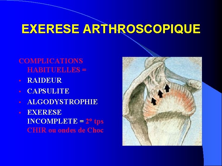 EXERESE ARTHROSCOPIQUE COMPLICATIONS HABITUELLES = • RAIDEUR • CAPSULITE • ALGODYSTROPHIE • EXERESE INCOMPLETE