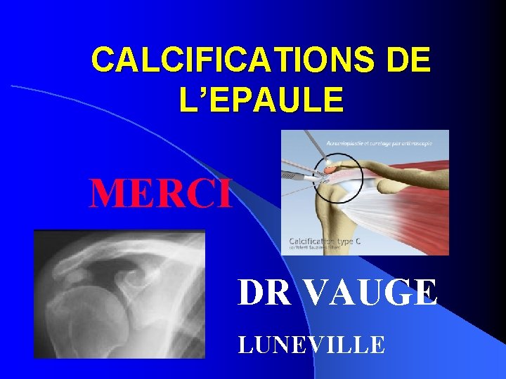 CALCIFICATIONS DE L’EPAULE MERCI DR VAUGE LUNEVILLE 
