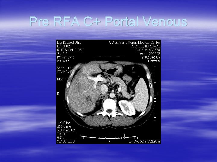 Pre RFA C+ Portal Venous 