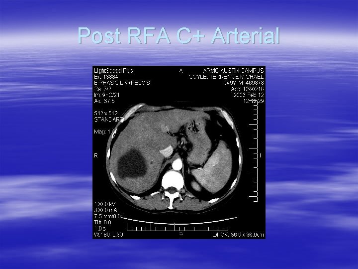 Post RFA C+ Arterial 