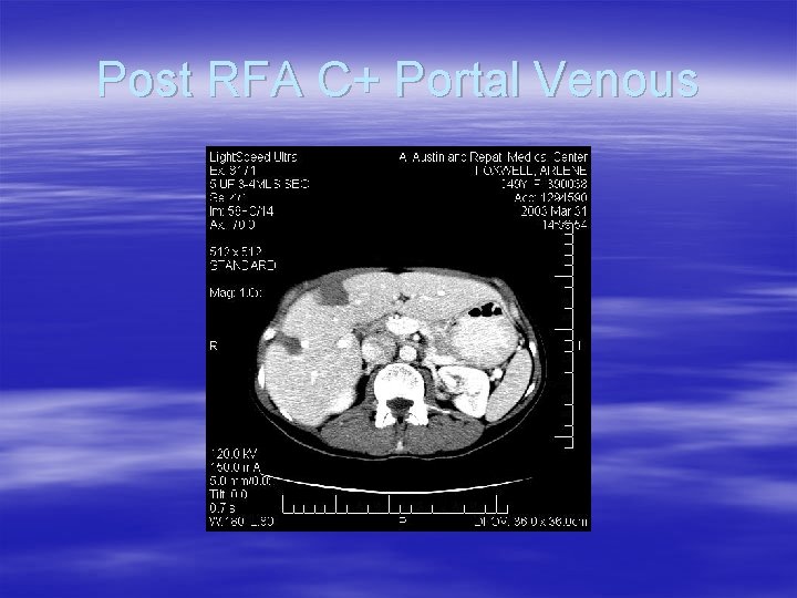 Post RFA C+ Portal Venous 