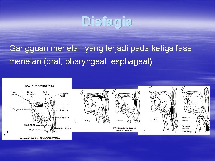Disfagia Gangguan menelan yang terjadi pada ketiga fase menelan (oral, pharyngeal, esphageal) 
