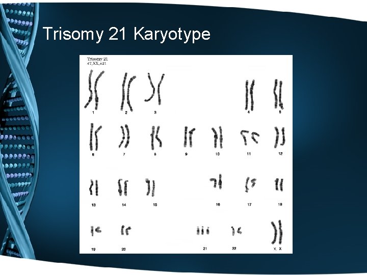 Trisomy 21 Karyotype 