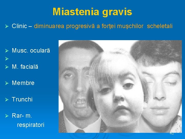 Miastenia gravis Ø Clinic – diminuarea progresivă a forţei muşchilor scheletali Ø Musc. oculară