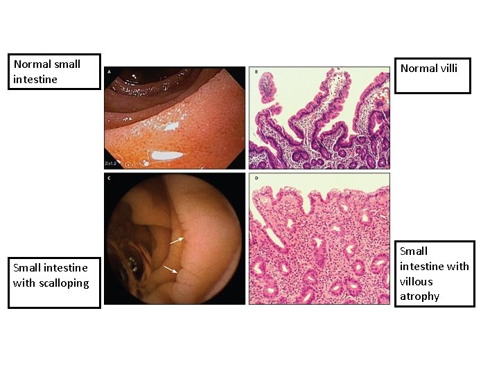 Normal small intestine Normal villi Small intestine with scalloping Small intestine with villous atrophy