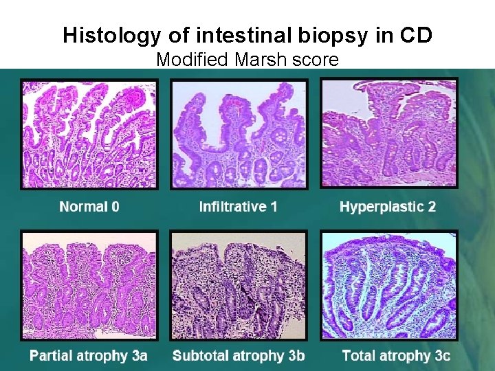 Histology of intestinal biopsy in CD Modified Marsh score 
